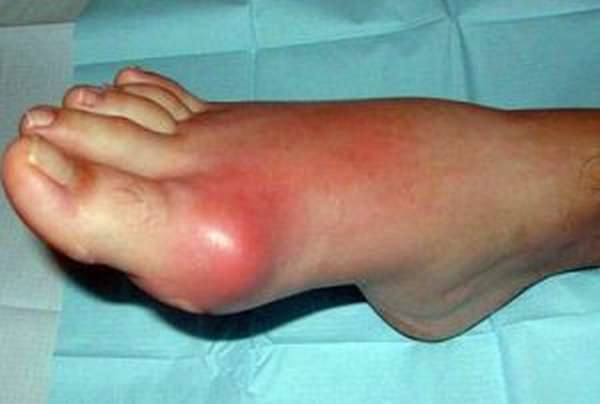 Вывих сустава пальца ноги